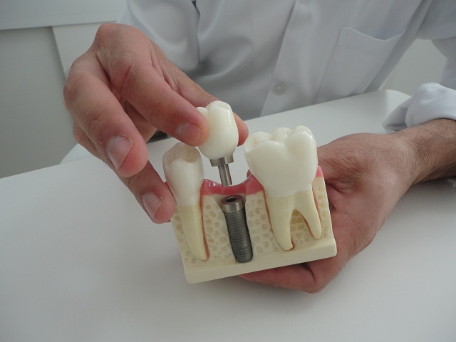 implante-dentario-004