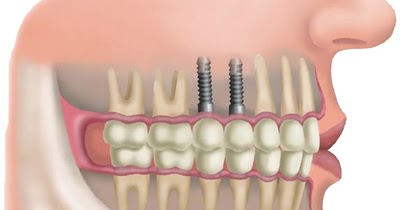 implante-dentario-preco